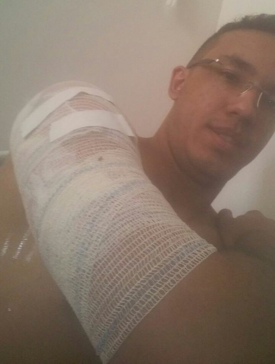 A imagem mostra Frederico Camargo, que ficou com queimaduras de segundo grau no ombro e braço após o acidente. Na foto ele mostra o braço enfaixado e com os curativos já feitos
