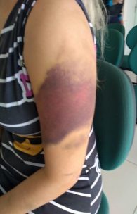 Hematoma no braço da mulher grávida agredida em Limoeiro do Norte. Marido agressor foi preso em flagrante
