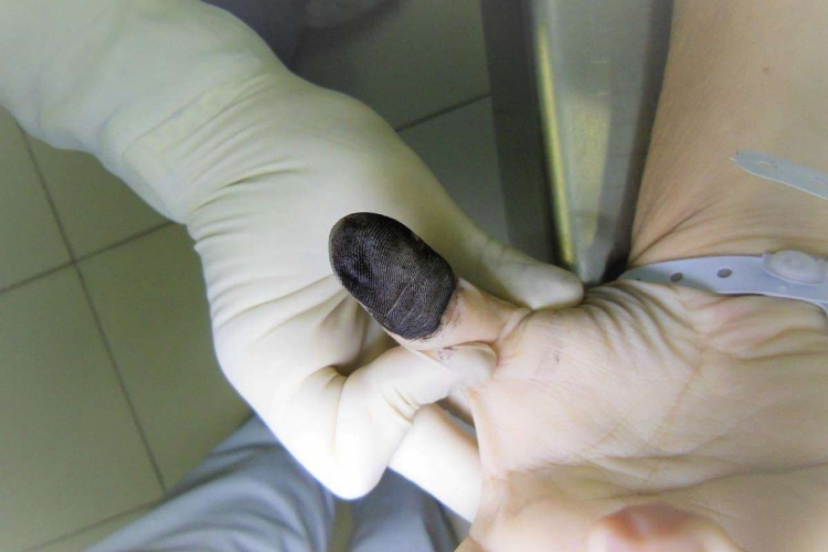 A família confundiu as certidões de nascimento e foi preciso fazer exames utilizando as impressões digitais