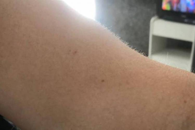 Vítimas sentiram ardência após o ataque com agulha