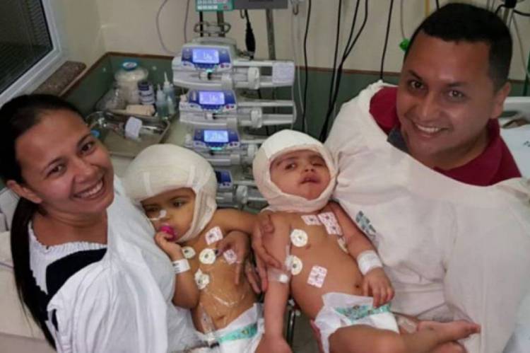 Separação das gêmeas foi concluída no outubro de 2018 Separação das gêmeas foi concluída no outubro de 2018