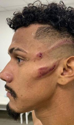 O meio-campista do Ceará Fernando Sobral postou o resultado da falta violenta cometida por Juninho, do Fortaleza