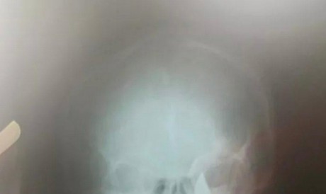 Mulher sobreviveu à tentativa de feminicídio e ficou com uma faca encravada no crânio 