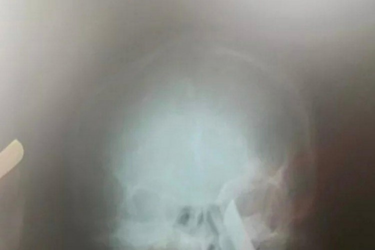 Mulher sobreviveu à tentativa de feminicídio e ficou com uma faca encravada no crânio