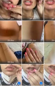 Pamella publicou no Instagram imagem mostrando as marcas da agressão sofrida.