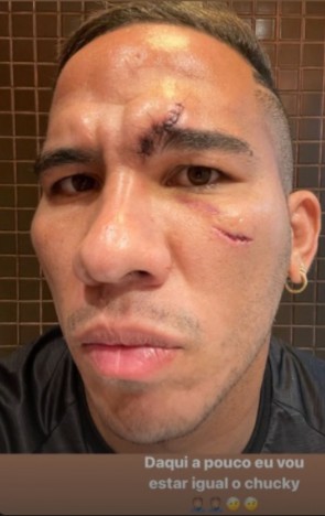 Jael levou pelo menos sete pontos na testa, acima do olho esquerdo