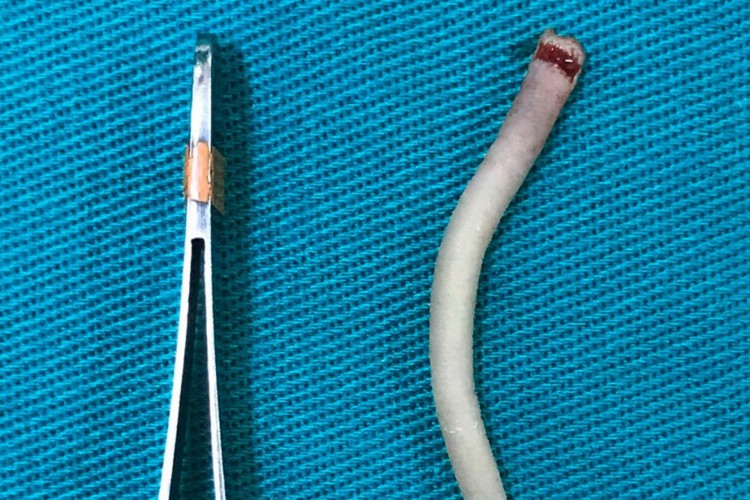 A cauda humana removida se trata de um apêndice cutâneo de 12 centímetros em região paravertebral lombossacra esquerda