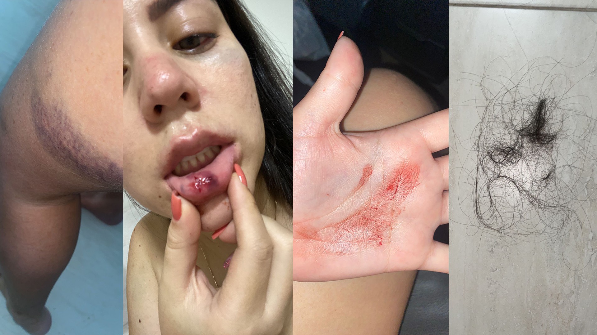 Fernanda mostra marcas da agressão que diz ter sofrido do ex-namorado