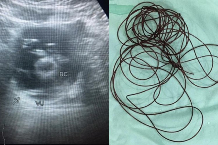 O homem de 37 anos foi internado após inserir 2 metros de nylon no pênis.