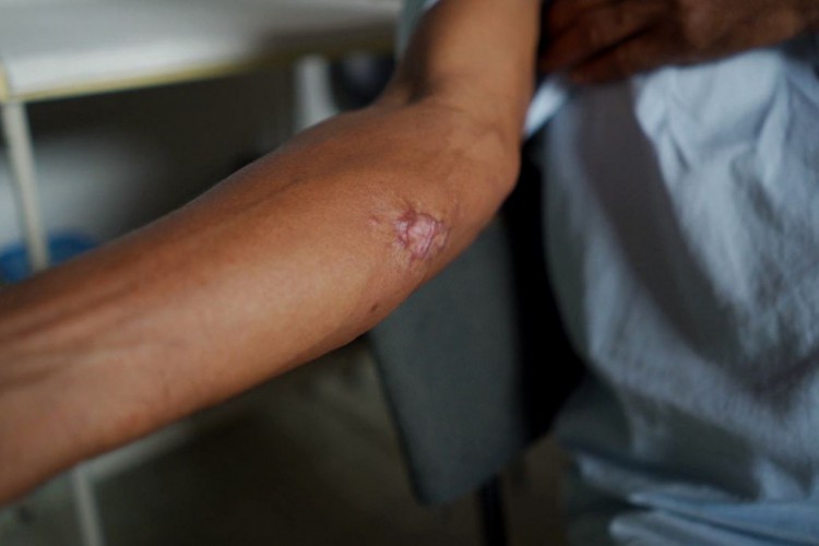 (foto de apoio ilustrativo) A Leishmaniose Visceral (LV) atinge a pele e mucosa. A doença ocorre por meio da picada de mosquitos transmissores para seres humanos