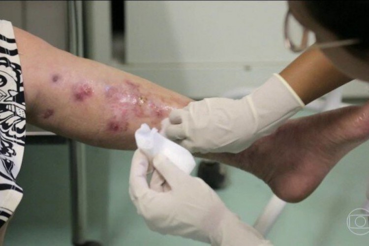 Humanos podem contrair a infecção em contato com lesões de animais ou com solo contaminado 