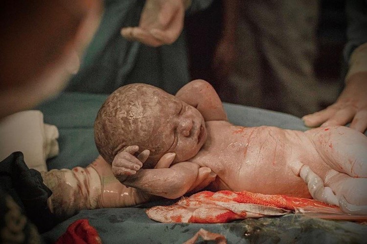Bebê nasce empelicado.