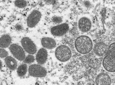Ceará tem segundo caso de varíola dos macacos 