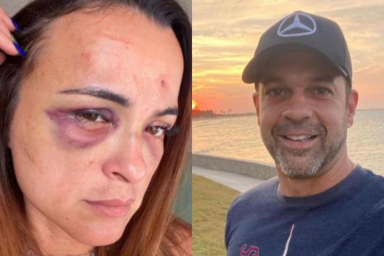Vanessa Araújo mostra marcas das agressões que diz ter sofrido do namorado Carlos Arthur