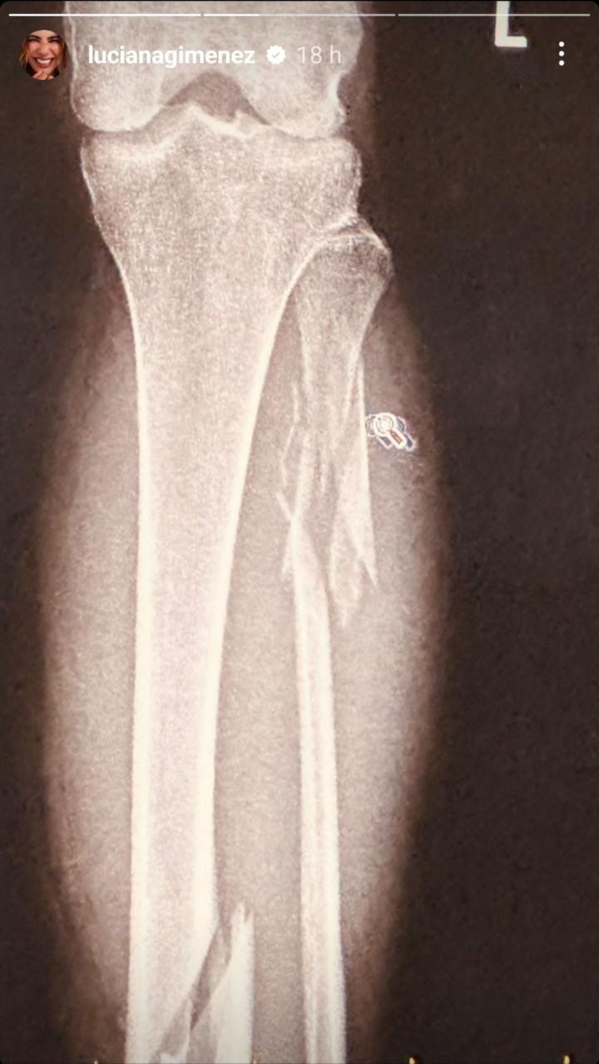 Luciana Gimenez divulgou o raio-x da perna fraturada após acidente grave