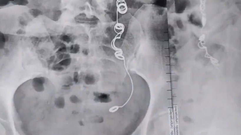 Colombiana que fez cirurgia em 2012 e conviveu mais de 10 anos com fortes dores no corpo descobriu uma agulha envolta de linha dentro de seu corpo
