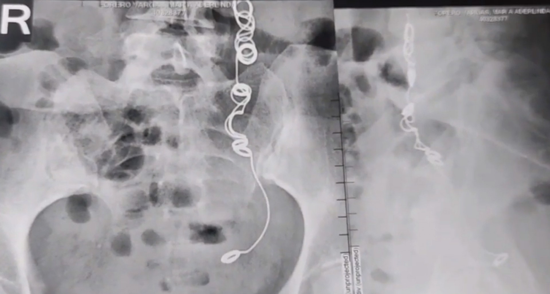 Colombiana que fez cirurgia em 2012 e conviveu mais de 10 anos com fortes dores no corpo descobriu uma agulha envolta de linha dentro de seu corpo 