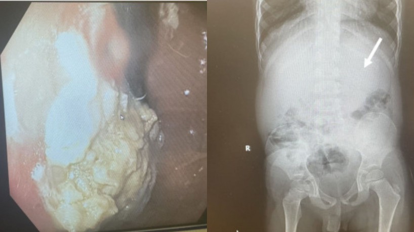 Estômago de criança estava sendo obstruído por acúmulo de goma de mascar