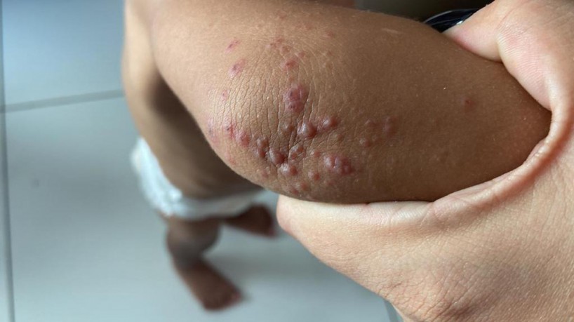 Entre os sinais da doença, está a erupção de pequenas bolhas 