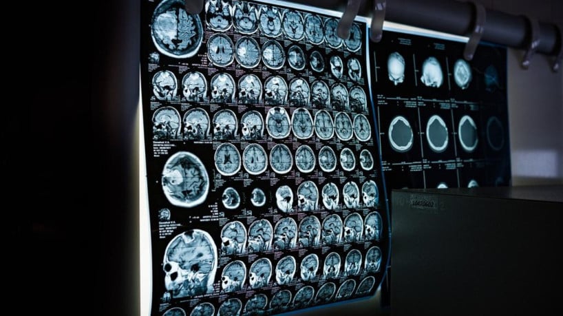 Foto de apoio ilustrativo: ressonância magnética do cérebro de uma pessoa