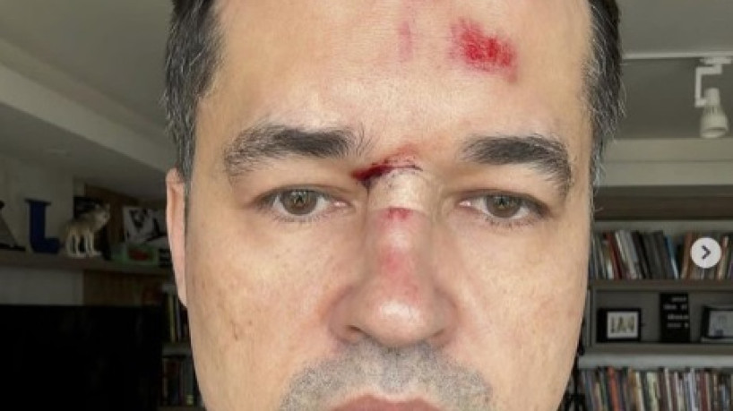 Deltan Dallagnol postou foto dos machucados da queda de bicicleta