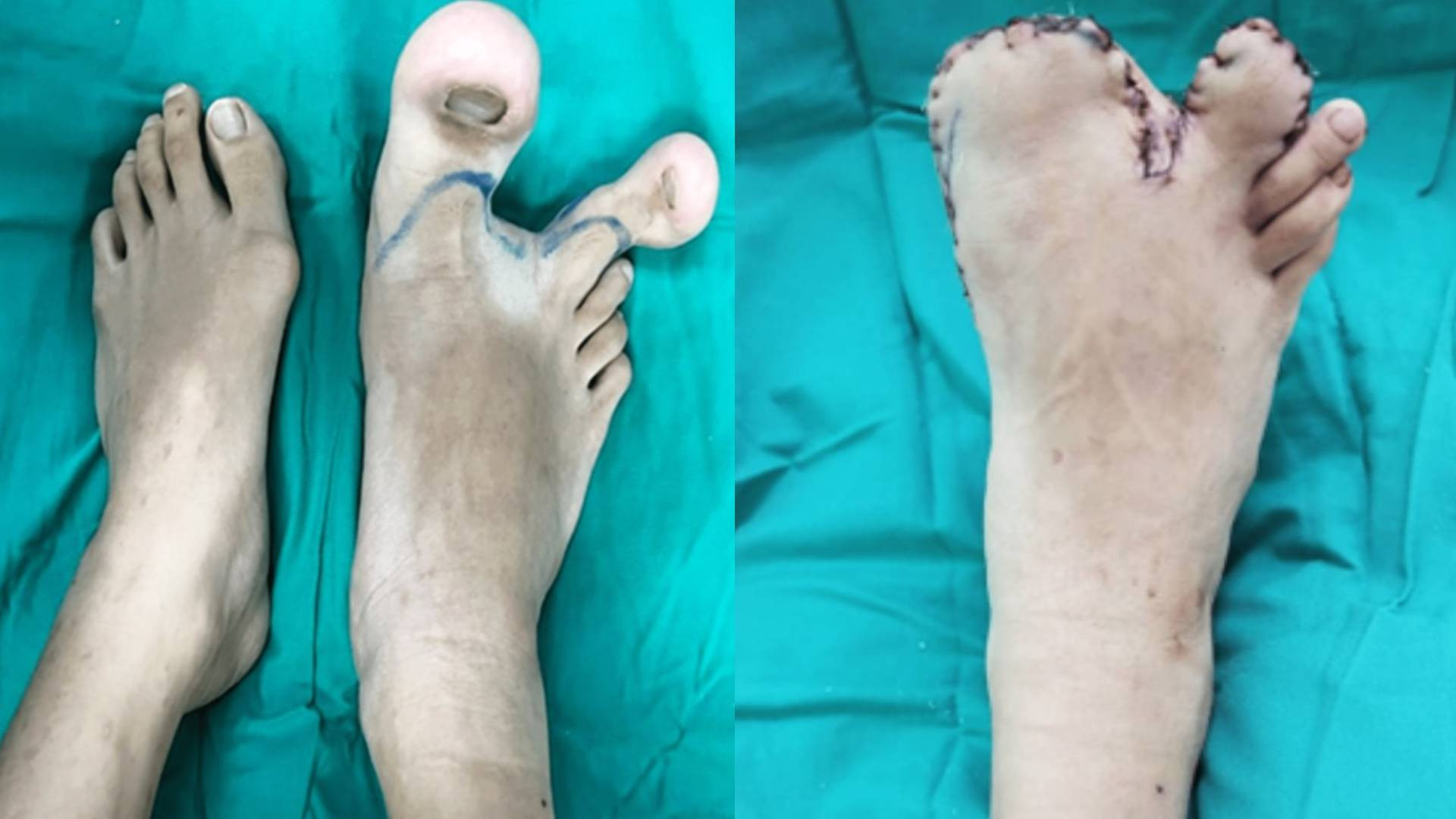 A menina de 12 anos, nascida em Kuala Lumpur, capital da Mal&aacute;sia, que tem dois dedos maiores do que o normal