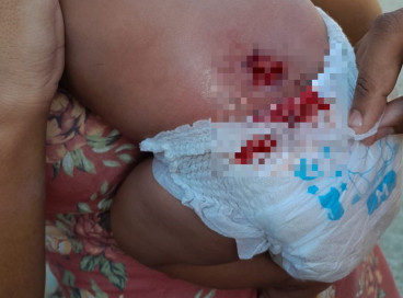 Bebê foi ferida na região lombar 