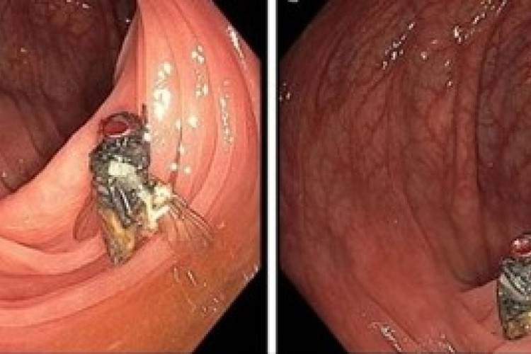 Médicos encontraram mosca intacta dentro do intestino de homem durante colonoscopia nos EUA 