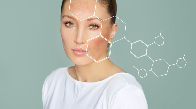 As manchas do melasma podem estar ligadas a alterações hormonais e ser desencadeadas pela luz solar (Imagem: LADO | Shutterstock)