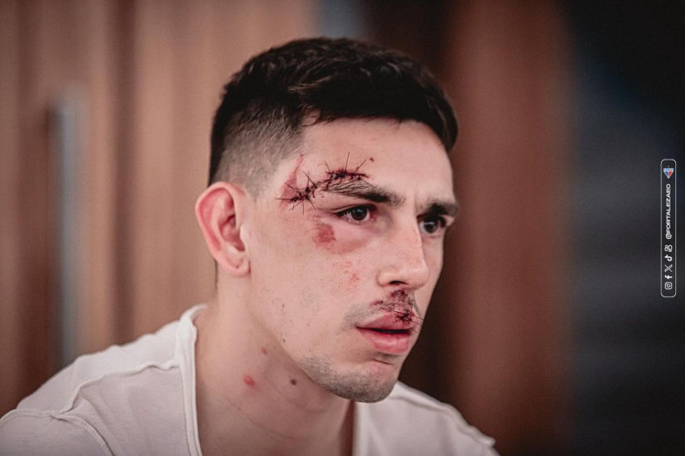 Gonzalo Escobar, jogador do Fortaleza, após sofrer atentado na última quarta-feira, 21