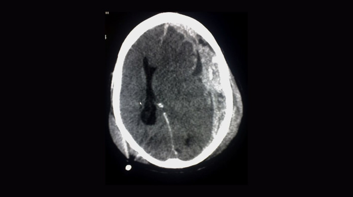 Exemplo de hemorragia subdural causada por trauma