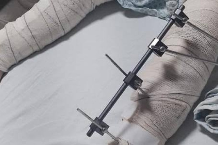 Menina de 6 anos tem a perna errada operada em cirurgia, em Campina Grande