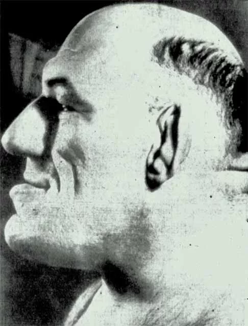 Quando estava na casa dos 20 anos, Tillet percebeu um inchaço estranho em várias partes do corpo, como pés, mãos e cabeça. Decidiu consultar um médico, que diagnosticou Acromegalia, uma condição causada por um tumor benigno na glândula pituitária.