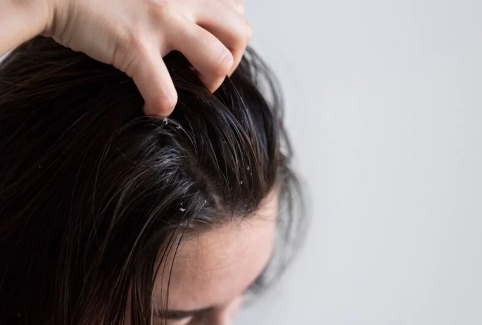  Além da coceira que provoca incômodo, a caspa cai na roupa, expondo a pessoa a uma situação vexaminosa. Veja algumas dicas simples para evitar a caspa no dia a dia. 