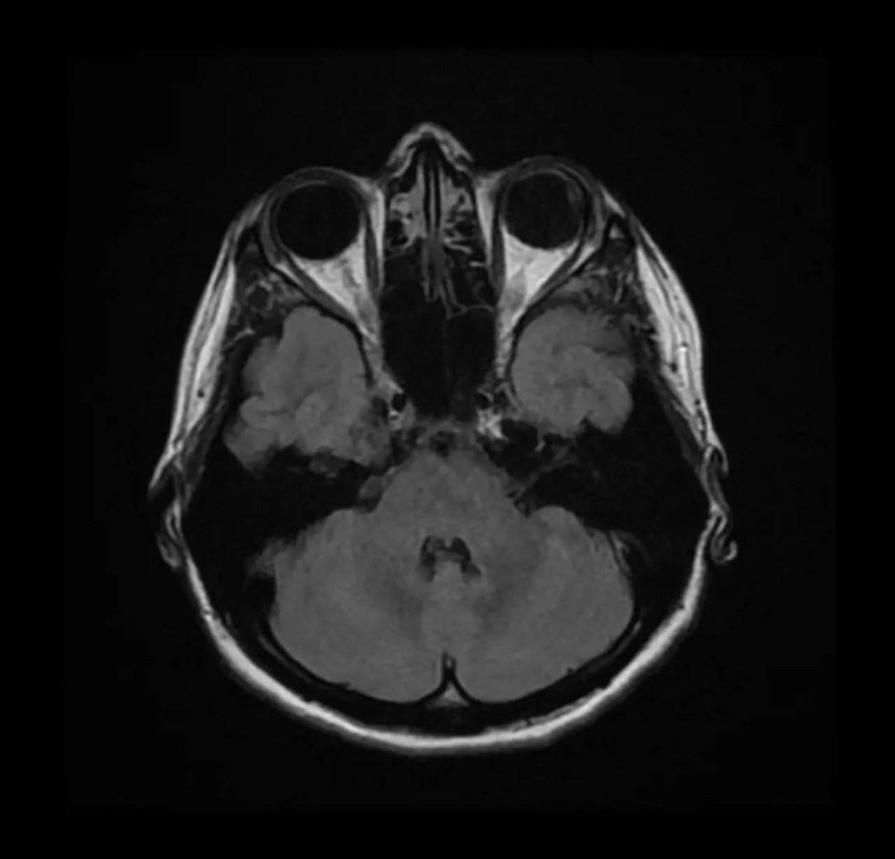A primeira opção de tratamento para Bree era radiação gama. Se funcionasse, ela manteria o olho.