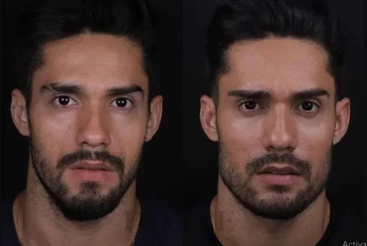 O modelo capixaba Bil Araújo fez harmonização facial antes de participar do BBB21. Ele ficou com o rosto mais volumoso, olheiras preenchidas e maxilar quadrado.