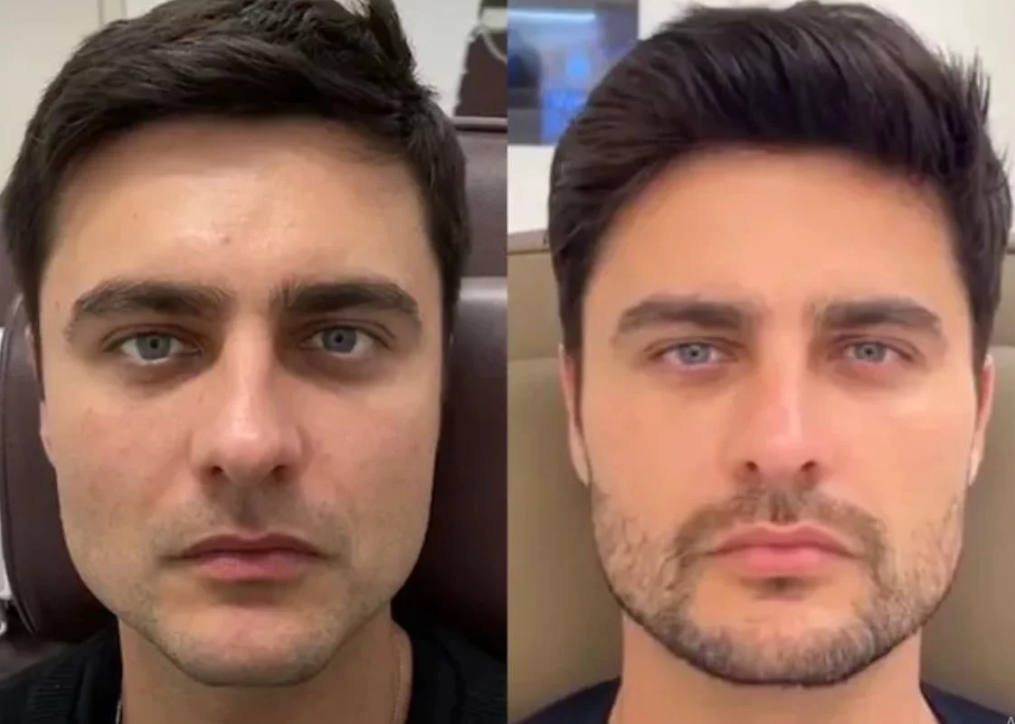 O ator gaúcho Guilherme Leicam fez preenchimento na mandíbula, malar, nariz, orelhas, queixo e têmpora, além da aplicação de toxina botulínica no rosto todo. 