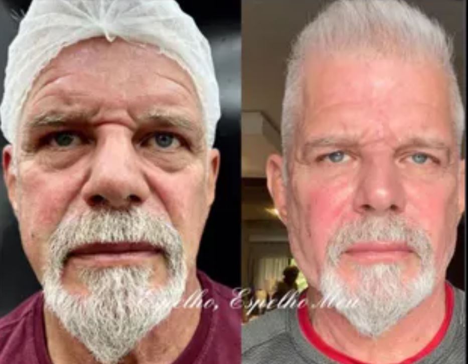 O ator carioca Raul Gazolla suavizou rugas e as olheiras, e definiu a mandíbula. Alguns anos a menos, postou, nas redes sociais. 