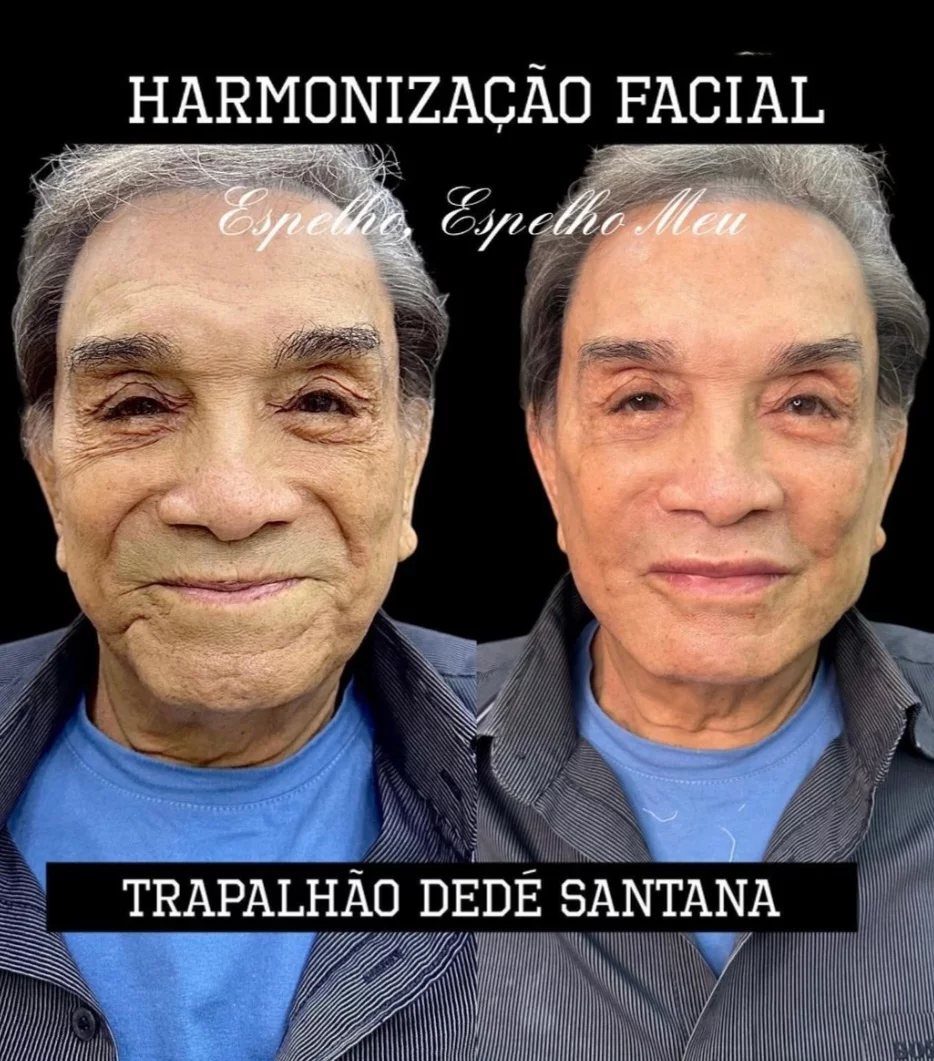Em fevereiro de 2023, o humorista Dedé Santana aderiu à onda e uma fã chegou a dizer que ele havia perdido 'uns 55 anos' com o procedimento. 