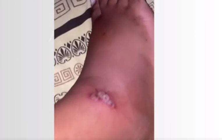 Além do cantor, a filha dela, que é enteada de Darlyn e tem 18 anos, também foi picada por uma aranha. Mas não teve a mesma reação grave do padrasto. Ela chegou a ser atendida no hospital, mas recebeu  alta. 