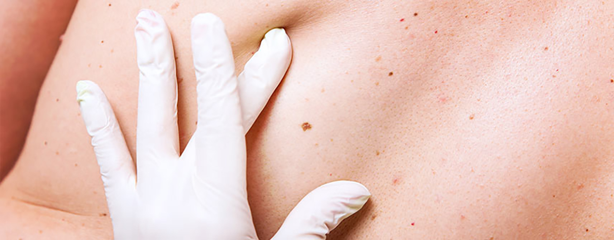 Em geral, a doença ataca mais as pessoas acima de 40 anos. A incidência tem níveis semelhantes entre os sexos, mas os homens morrem mais.  Existem quatro tipos de melanomas, que são os mais raros, mas também os mais agressivos. O mais comum é o extensivo superficial. É o mais temido pelos jovens.