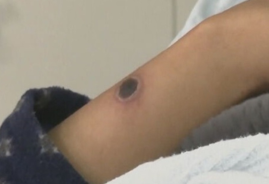 As lesões na pele podem ser planas ou levemente elevadas, e são preenchidas por um líquido claro ou amarelado. Conforme a doença evolui, podem formar crostas, que secam e caem. 