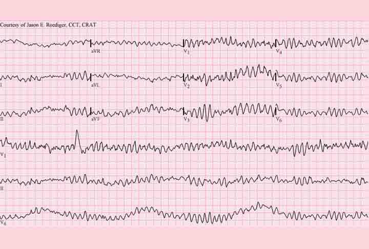 As alterações nesse funcionamento podem fazer o coração bater em ritmo muito acelerado (taquicardia) ou lento demais (bradicardia). A maioria das arritmias são benignas e não causam sintomas, porém algumas podem levar a situações preocupantes para a saúde.