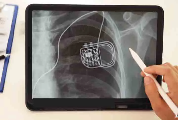 Por outro lado, nos casos de bradicardias (coração lento), os pequenos marca-passos, que emitem impulsos elétricos para corrigir falhas no ritmo dos batimentos, podem ser implantados.