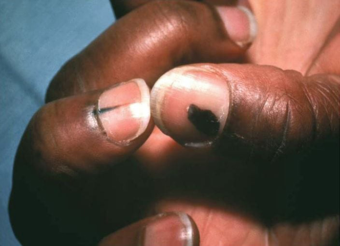O melanoma Acral Lentiginoso é o mais comum em pessoas de pele negra ou asiática. E é o menos comum em pessoas de pele branca. Ele é traiçoeiro, pois pode surgir embaixo da unha, sem que as pessoas percebam. Já o melanoma lentigo maligno acomete mais os idosos e é o mais ligado à exposição solar ao longo da vida. 