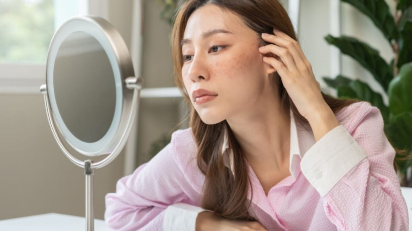 O melasma pode ser desencadeado por diversos fatores (Imagem: Kmpzzz | Shutterstock)