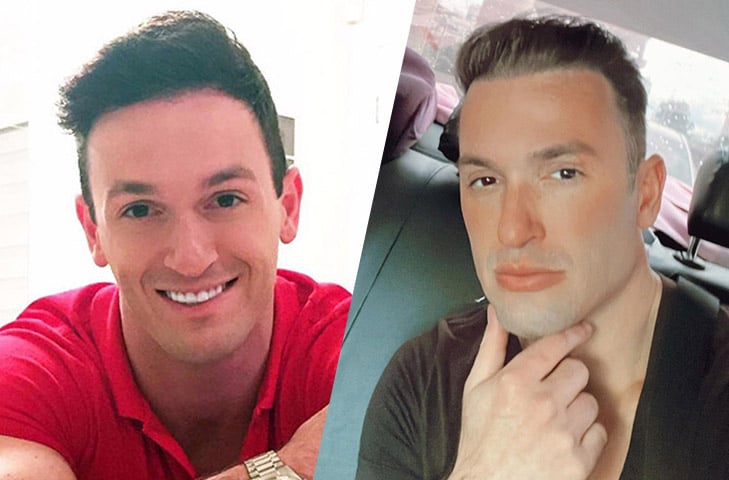 O ex-ginasta paulista Diego Hypólito fez o procedimento para múltiplos ajustes. Ele alinhou o nariz, empinou o queixo e fez preenchimento no lábio superior.