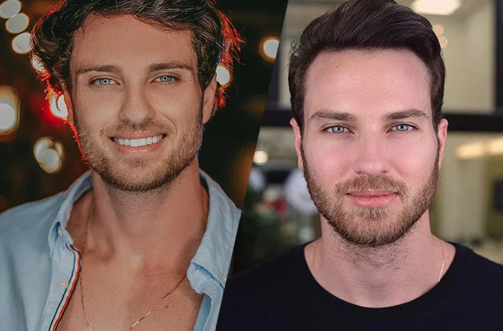 Mattar fez o procedimento na mesma clínica que atendeu ao ex-BBB Lucas Bissoli. Lucas também optou por dar uma guaribada no rosto e publicou a comparação nas redes sociais. 