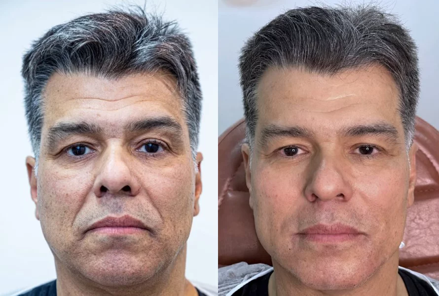 O ator carioca Maurício Mattar fez harmonização em julho de 2022 e comemorou o resultado.  Ele achou que a suavização deu certo e postou a comparação em suas redes sociais. 