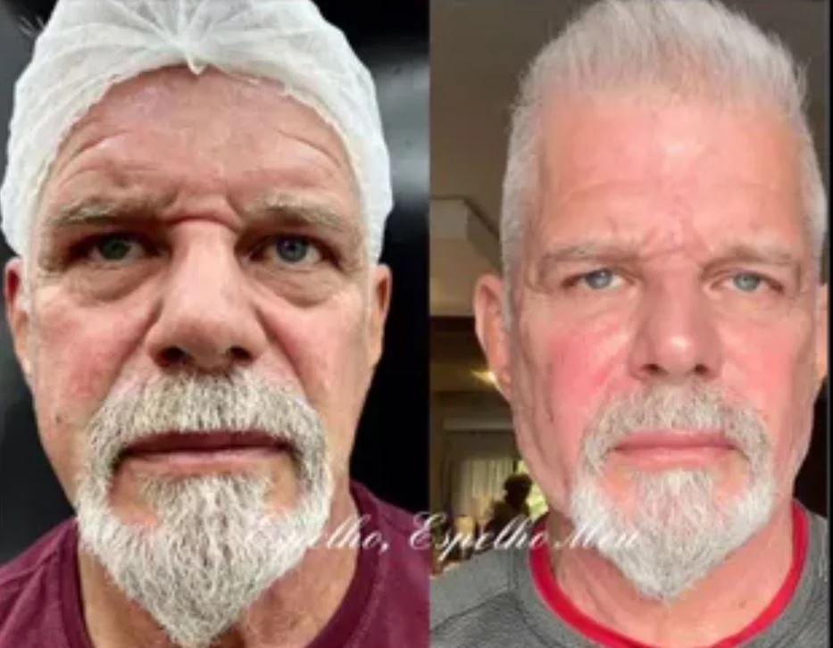 O ator carioca Raul Gazolla suavizou rugas e as olheiras, e definiu a mandíbula. Alguns anos a menos, postou, nas redes sociais. 